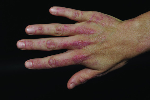 Inflammatory Arthritis Treatment